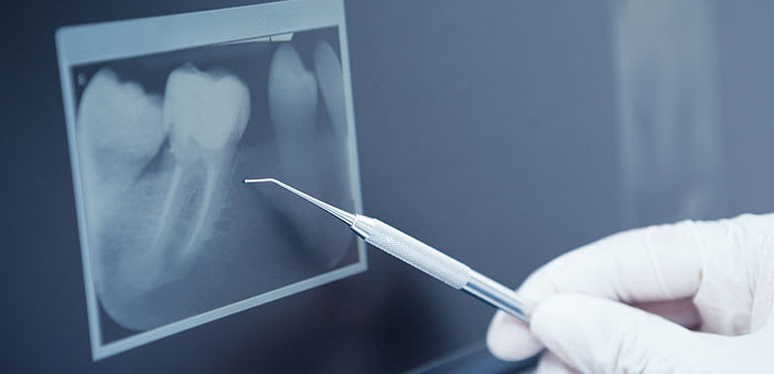 Root Canal | Orangeville Dental